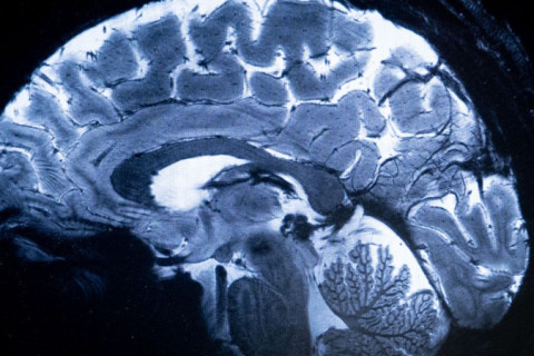AVC pode provocar 9,7 milhões de mortes até 2050, aponta estudo