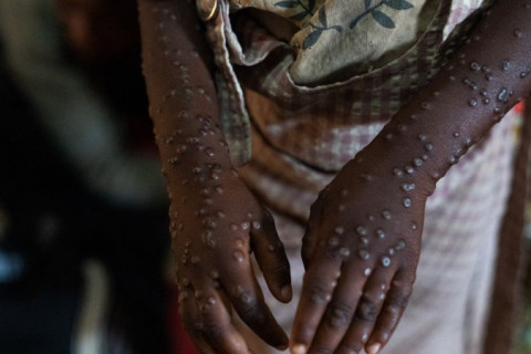 Mpox em alta: Brasil se aproxima da marca de 90 casos confirmados