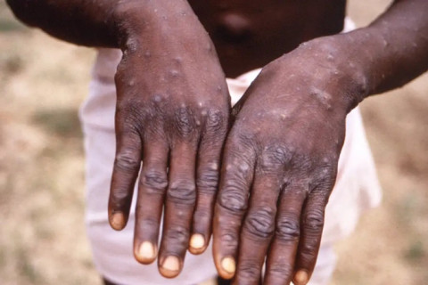 Ministério da Saúde envia equipe para monitorar caso de Mpox em São Paulo