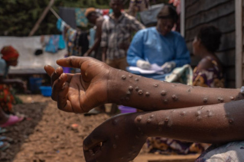 Mais de 1,5 mil casos de Mpox foram registrados no Brasil em 2024