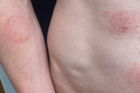 Superfungo genital: saiba mais sobre infecção que se espalha na Europa